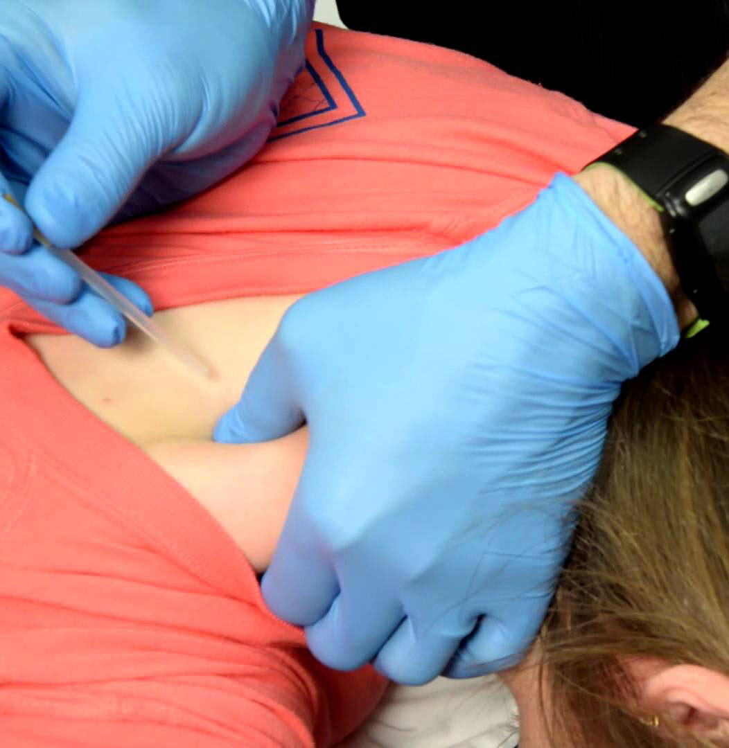 Trigger Point Dry Needling (TDN) - Boulder Therapeutics